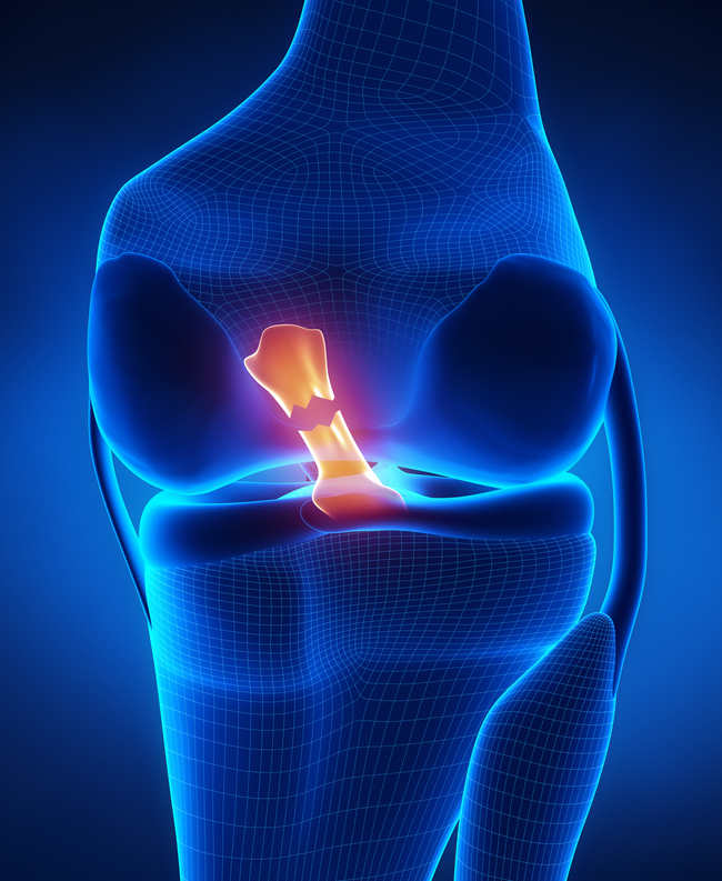Lesioni del legamento